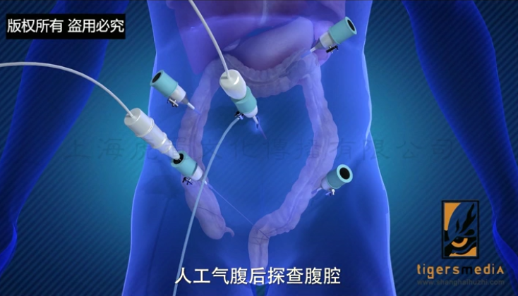 直肠癌.png
